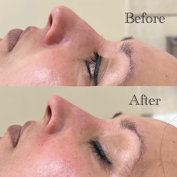 nose job